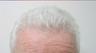 Hair Transplant