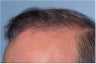 Hair Transplant
