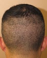 Neograft hair transplant donor site