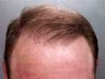 Hair Transplant