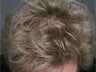 Hair Transplant