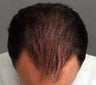 Hair Transplant