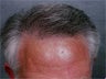 Hair Transplant