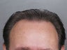 Hair Transplant