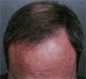 Hair Transplant