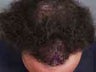 Hair Transplant
