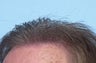 Hair Transplant
