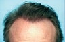 Hair Transplant
