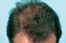 Hair Transplant