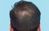 Hair Transplant