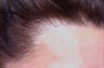 Hair Transplant