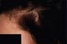 Hair Transplant