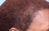 Hair Transplant