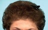 Hair Transplant
