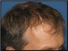 Hair Restoration
