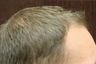 NeoGraft hair transplant