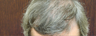 NeoGraft hair transplant