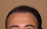 FUE hair transplantation