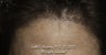 AccuGraft Hair Transplant