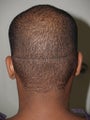 Hair Transplant - Follicular Unit Extraction