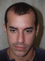 Hair Transplant
