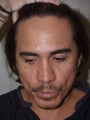 Hairline Advancement