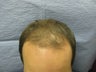 Hair Transplantation