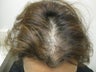 Hair Transplantation