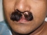 Facial Hair Transplant