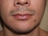 Facial Hair Transplant