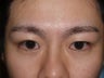 Eyebrow Transplant