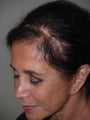 Hair Transplant