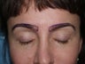 Eyebrow Transplant