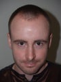 Hair Transplant