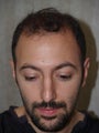 Hair Transplant