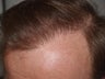 Hair Transplant Reparative Procedure