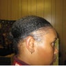 Hair Transplant 1400 Grafts