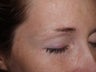 Eyebrow Transplant