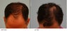 Hair Transplant