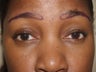 Eyebrow Transplantation
