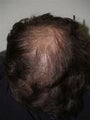 Hair Transplant