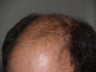 Hair Transplant