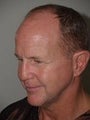 Extended Midfacelift and Hair Transplant