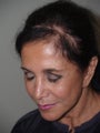 Hair Transplant into Scar