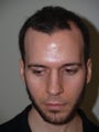 Hair Transplant