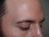 Eyebrow Transplant