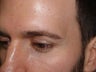 Eyebrow Transplant