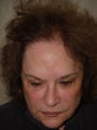 Hair Transplant