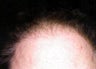 Hair Replacement