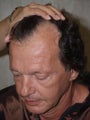 Hair Transplant